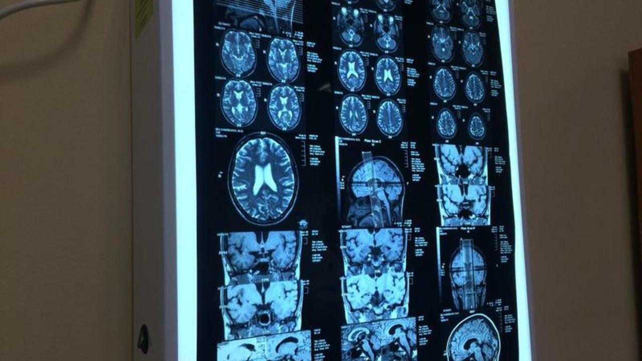 Житель Удмуртии более 30 лет живет с пулей в головном мозге